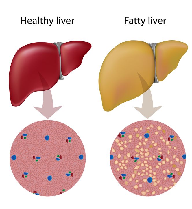 17754258 - fatty liver disease